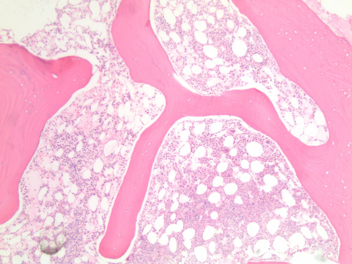 Day 22 bone marrow core biopsy low power